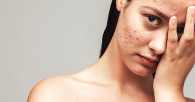 Acne Marks