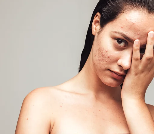 Acne Marks