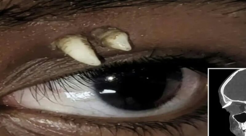 Ectopic Tooth
